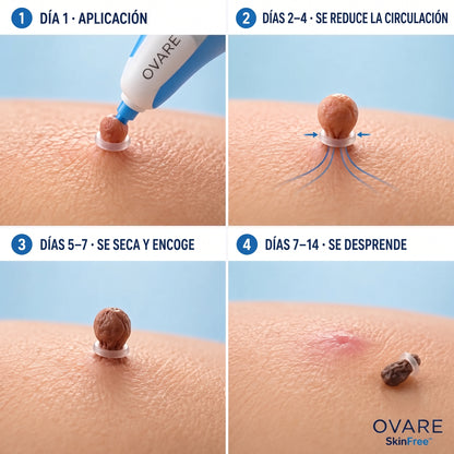 Kit removedor de verrugas