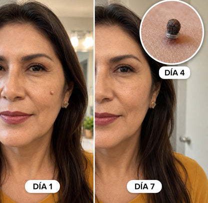 Kit removedor de verrugas